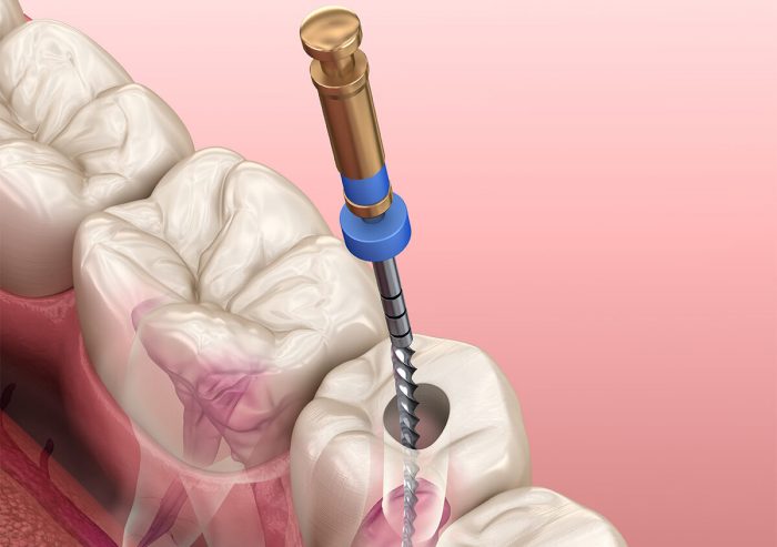 Root Canal Specialist near me