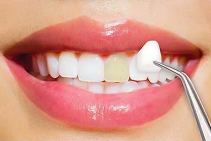 Root Canal Dentist In Houston, Tx