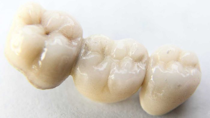 What Is A Dental Bridge?