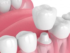 What Is A Dental Crown?