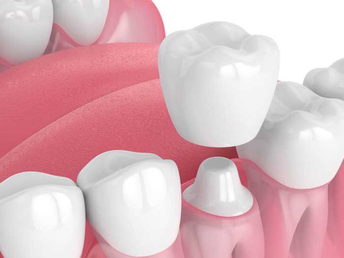 What Is A Dental Crown?