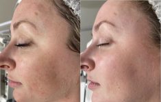 Before and After Pictures of Brazilian Butt Lift