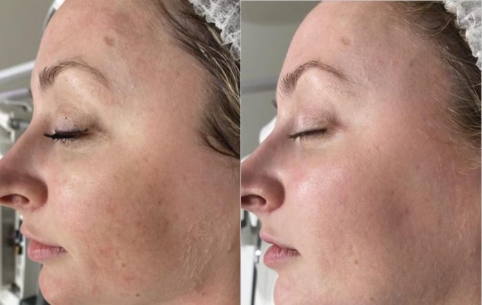 Before and After Pictures of Brazilian Butt Lift