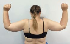 Arm Liposuction in Houston