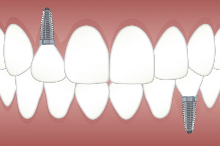 Permanent Teeth Replacement Options