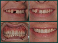How to Replace Missing Tooth with Dental Implant?
