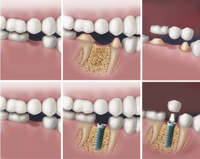 How to Replace Missing Tooth with Dental Implant?