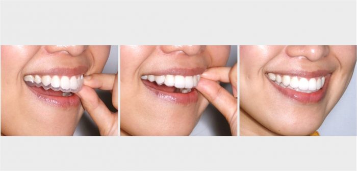 Invisalign Clear Braces in Houston