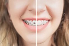 Finding The Best Orthodontist For Braces
