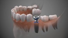Dental Implants in Uptown Houston TX