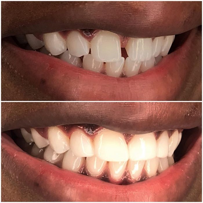 Dental Bonding in Miami