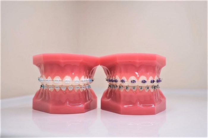 Affordable Braces In Miami Shores, Fl