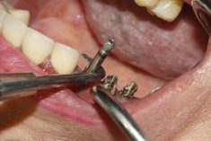 Dental Implant Removal Near Me