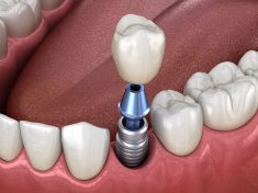 Dentist That Do Implants In Houston Tx
