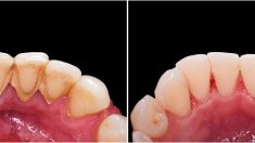 Deep Teeth Cleaning Near Me | Teeth Cleaning Before And After
