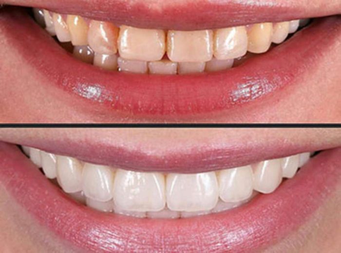 Affordable Dental Veneers Near Me | Dental Veneers Cost Houston