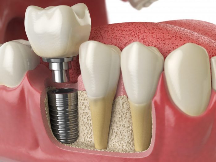 Affordable Dental Implants Clinic