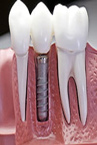 Dental Implants Service in North Miami