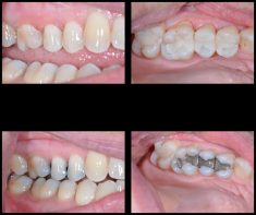 Fix Cavity on Front Tooth | Composite Front Tooth Cavity Filling or Bonding