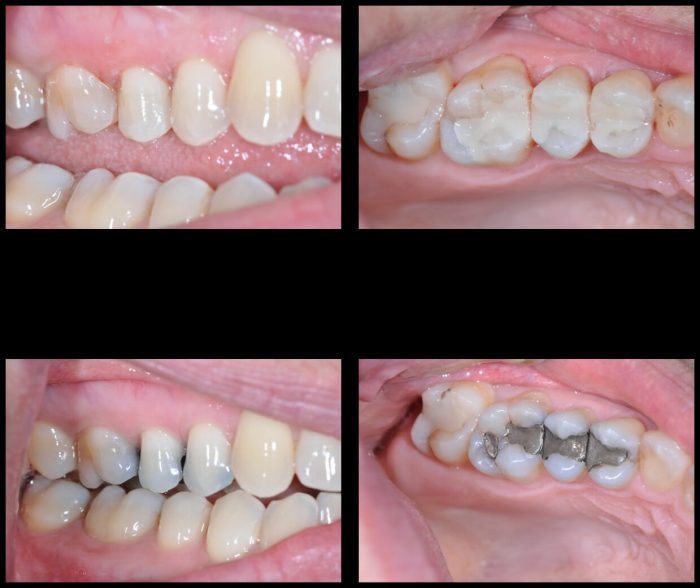 Fix Cavity on Front Tooth | Composite Front Tooth Cavity Filling or Bonding