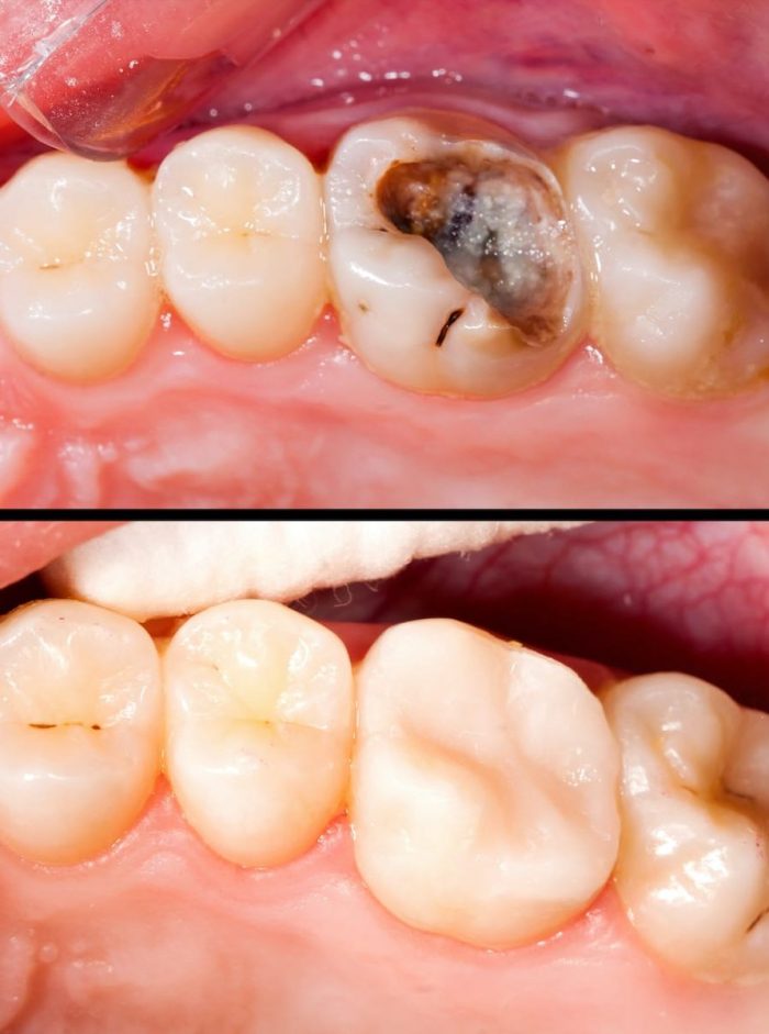 Fix Cavity on Front Tooth | Composite Front Tooth Cavity Filling or Bonding