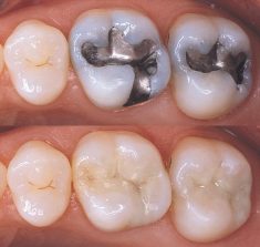 Fix Cavity on Front Tooth | Composite Front Tooth Cavity Filling or Bonding