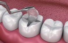 What’s The Reason For Temporary Filling On Tooth And Not Permanent?