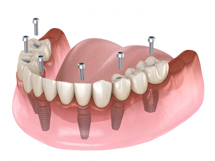 All On 4 Dental Implants Near Me