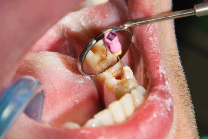 Root Canal Treatment Near Me