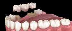 Affordable Dental Crowns in Houston, TX