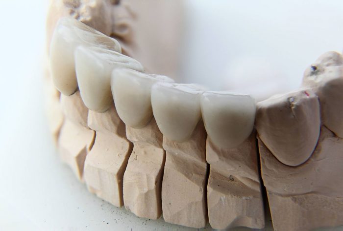 Porcelain Dental Crowns Near Me