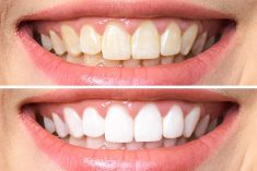 Teeth Whitening Treatment in Miami