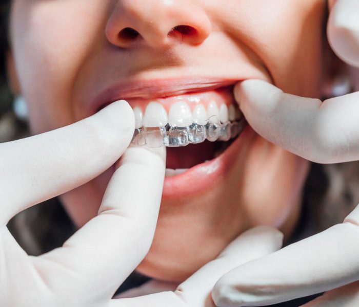 Invisalign Near Me Online Search | Find an Invisalign Doctor