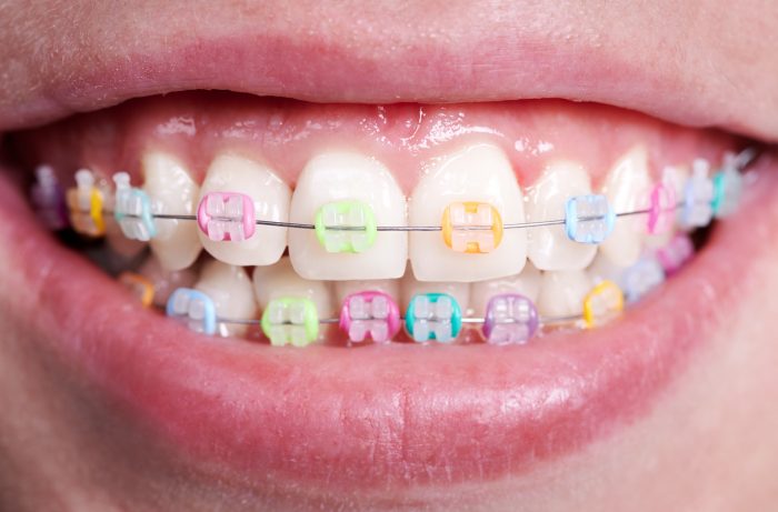 What Are The Best Braces Colors? | Colored Braces and Bands