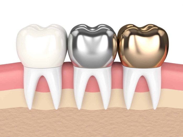 Benefits of Dental Crown Procedure | Dental Crown Near Me