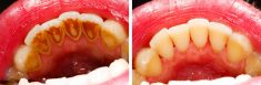Laser Treatment For Gum Disease | Treatment of Gum Disease
