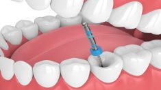 Root Canal Dentist in Sunny Isles