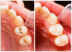 Dental Filling and Tooth Cavity Filling