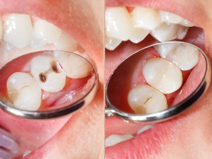 Lost Dental Filling Treatment in Houston, TX