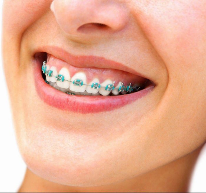 Choose The Best Colors For Your Braces