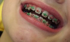Best Braces Color Ideas