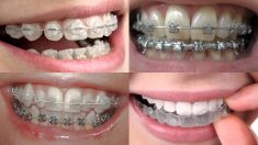 Affordable Braces Near Me
