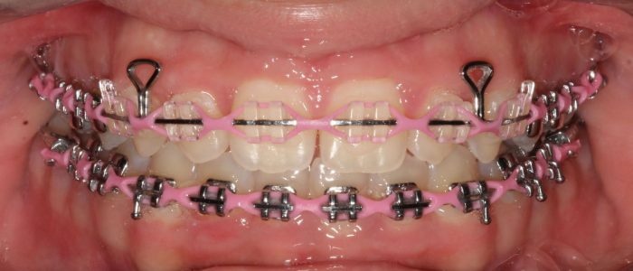 Choose the Best Colors for your Braces