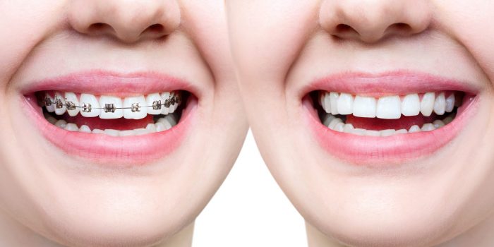 Comfort Dental Braces in Miami, Fl