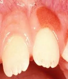 What Causes Swollen Gums? | How To Get Rid Of Swollen Gums?