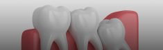 Wisdom Tooth Pain Relief | Wisdom Teeth Pain Symptoms