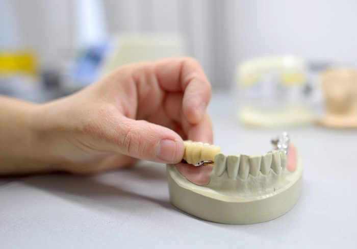 Dental Tooth Supported Bridge