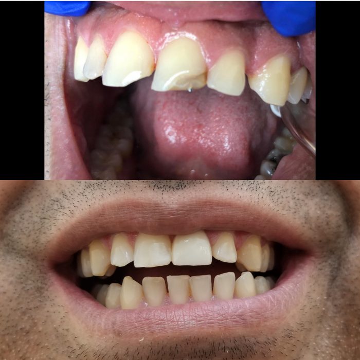 Dental Crowns in North Miami