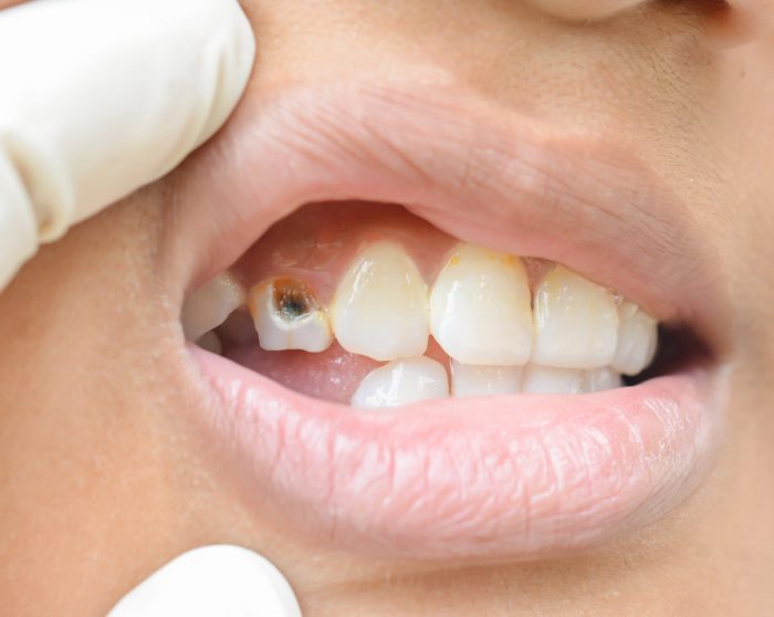 Need a Cracked Tooth Extraction?