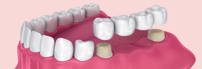 Cosmetic Dental Bridge Houston